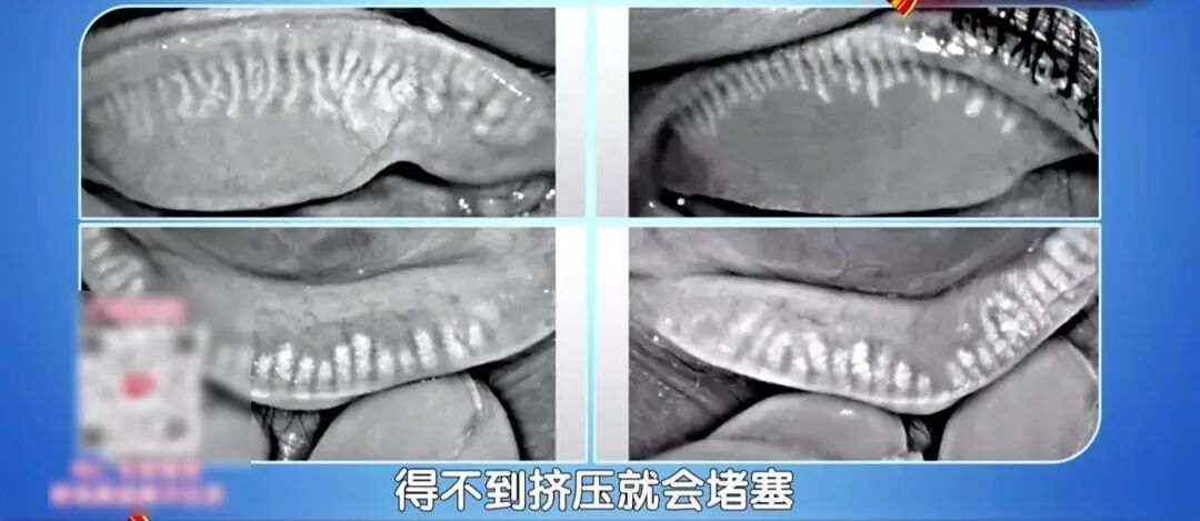 一个毁掉视力的习惯，你可能天天做，两个小动作帮你减少眼部损伤