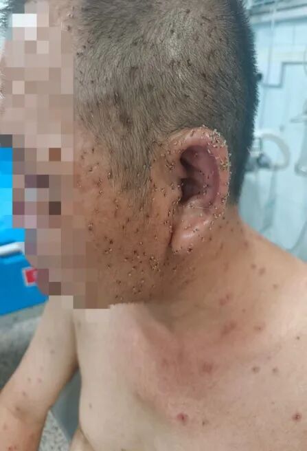 男子遭群蜂“围堵”，急诊3人拔刺小组鏖战3小时，拔除千根毒刺！