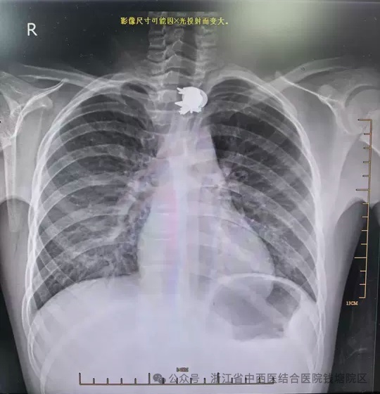 10岁男孩边玩边说笑，一口吞下少先队队徽！医生提醒……