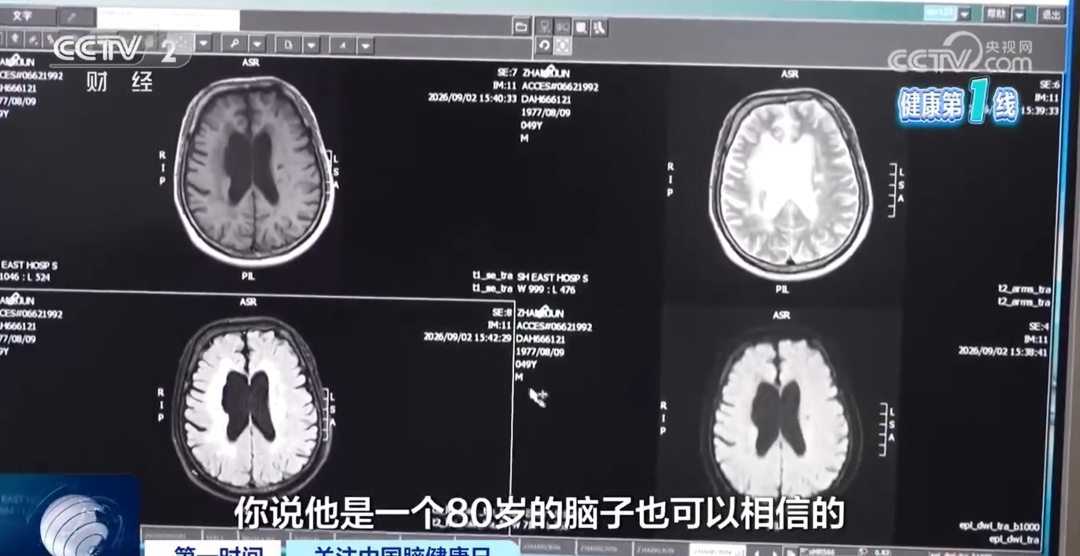 男子长期熬夜,确诊血管性痴呆!大脑萎缩如80岁!这些伤脑行为你可能天天做! 男子长期熬夜,确诊血管性痴呆!大脑萎缩如80岁!这些伤脑行为你可能天天做!