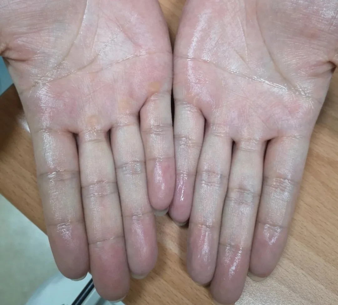 姑娘的手刚碰过来,20多岁小伙就慌忙闪躲!相亲屡屡受挫,原因竟是难以启齿的手汗 姑娘的手刚碰过来,20多岁小伙就慌忙闪躲!相亲屡屡受挫,原因竟是难以启齿的手汗
