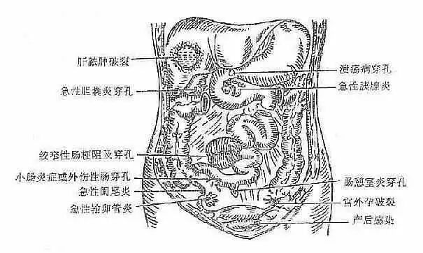 这些情况会引发腹膜炎,千万别忽视 这些情况会引发腹膜炎,千万别忽视