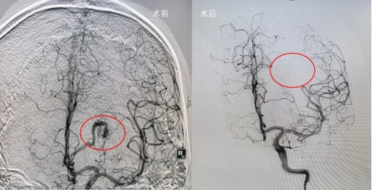 吃饱就困,当心是脑血管被“引爆”,别只当晕碳,3种表现,占得越多越危险 吃饱就困,当心是脑血管被“引爆”,别只当晕碳,3种表现,占得越多越危险