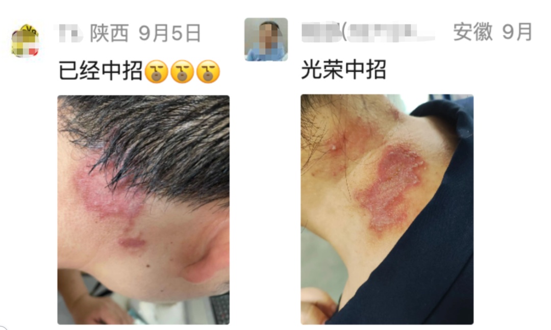 注意！这只“硫酸虫”最怕你“手快”！正确处理只要2步
