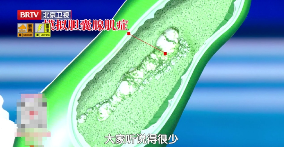 比胃癌更凶的“新晋癌王”，3个吃饭习惯再不改就晚了，尤其女性