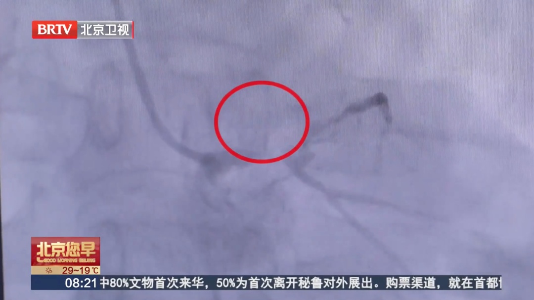 背痛硬扛,男子突然晕倒,心肌竟大面积坏死!医生提醒:7种疼痛是心脏在求救 背痛硬扛,男子突然晕倒,心肌竟大面积坏死!医生提醒:7种疼痛是心脏在求救