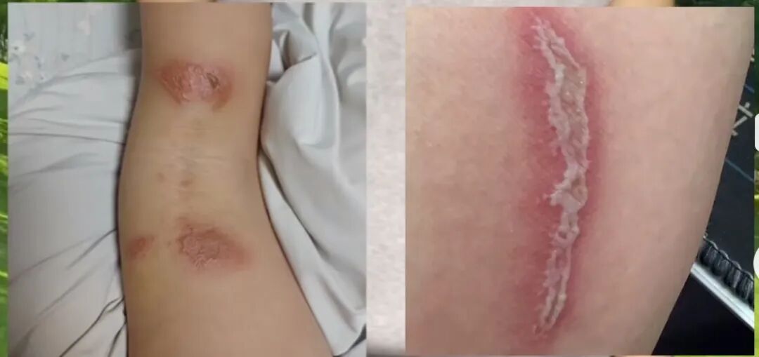 一觉醒来脸上、胳膊上大片红肿，犹如鞭痕......医生：它的腐蚀性堪比硫酸，8-9月正是活跃期