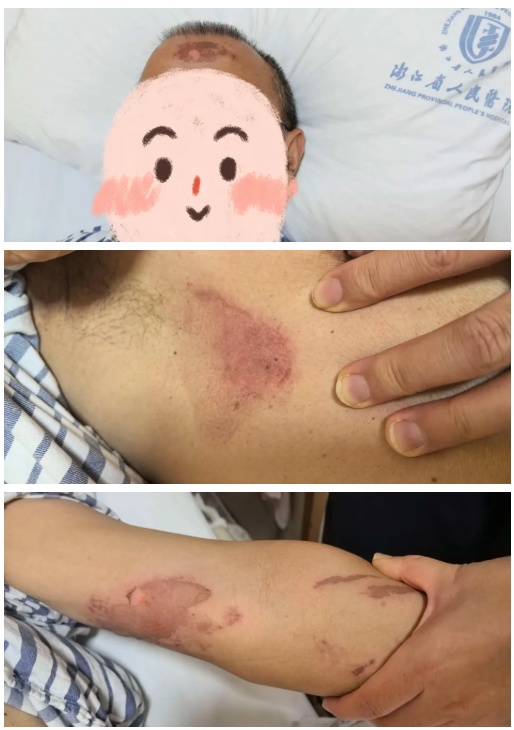 好心办坏事!女儿用干冰给爸爸退烧,结果敷出一身冻伤 好心办坏事!女儿用干冰给爸爸退烧,结果敷出一身冻伤