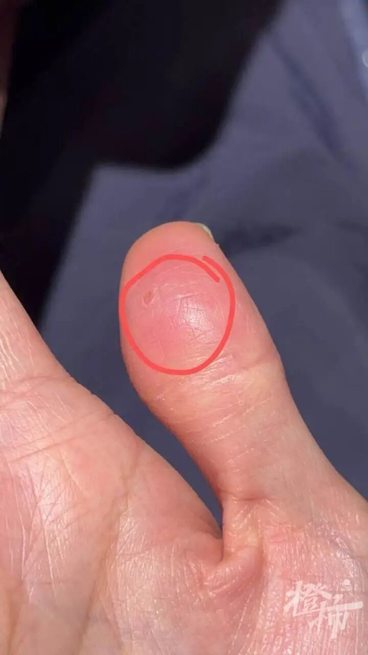 手机贴膜竟成“暗器”?多人手指被扎出血,有人被迫切了一块肉!这种膜赶紧换 手机贴膜竟成“暗器”?多人手指被扎出血,有人被迫切了一块肉!这种膜赶紧换