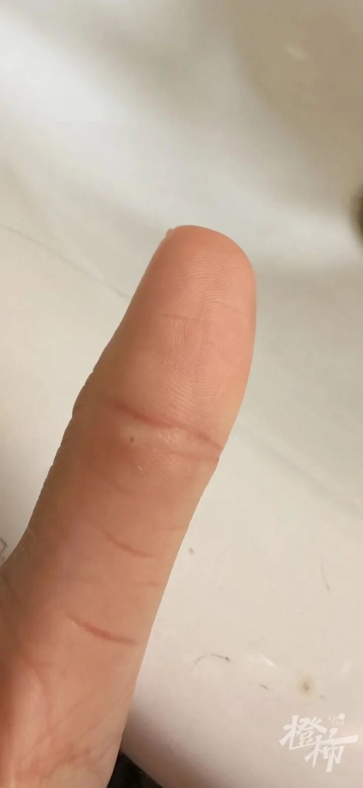 手机贴膜竟成“暗器”?多人手指被扎出血,有人被迫切了一块肉!这种膜赶紧换 手机贴膜竟成“暗器”?多人手指被扎出血,有人被迫切了一块肉!这种膜赶紧换