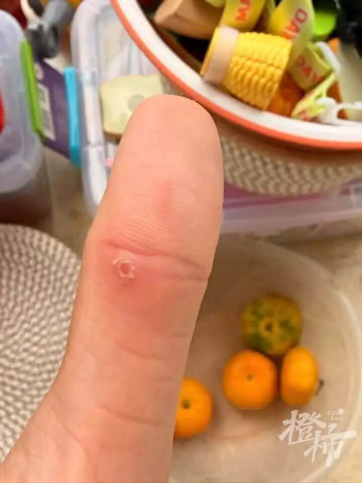 手机贴膜竟成“暗器”?多人手指被扎出血,有人被迫切了一块肉!这种膜赶紧换 手机贴膜竟成“暗器”?多人手指被扎出血,有人被迫切了一块肉!这种膜赶紧换