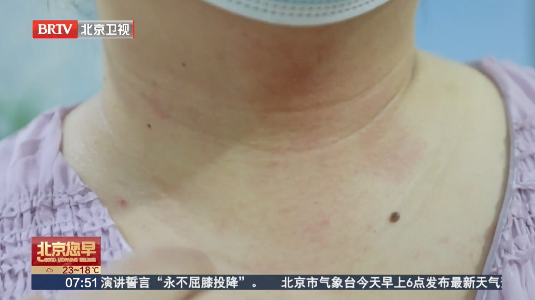 脸上红、肿、痒,用了过敏药怎么都不好?医生:你可能一直做错了! 脸上红、肿、痒,用了过敏药怎么都不好?医生:你可能一直做错了!