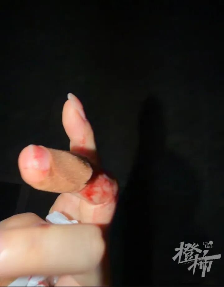 手机贴膜竟成“暗器”?多人手指被扎出血,有人被迫切了一块肉!这种膜赶紧换 手机贴膜竟成“暗器”?多人手指被扎出血,有人被迫切了一块肉!这种膜赶紧换