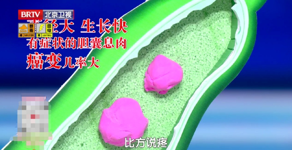 比胃癌更凶的“新晋癌王”，3个吃饭习惯再不改就晚了，尤其女性