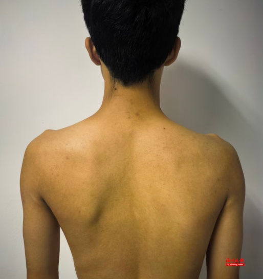 已严重变形！福州16岁男生确诊！医生给他钉了13枚钉子