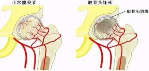 被称为“不死癌症”的股骨头坏死，6类人群高发，7种早期症状请对照自查！