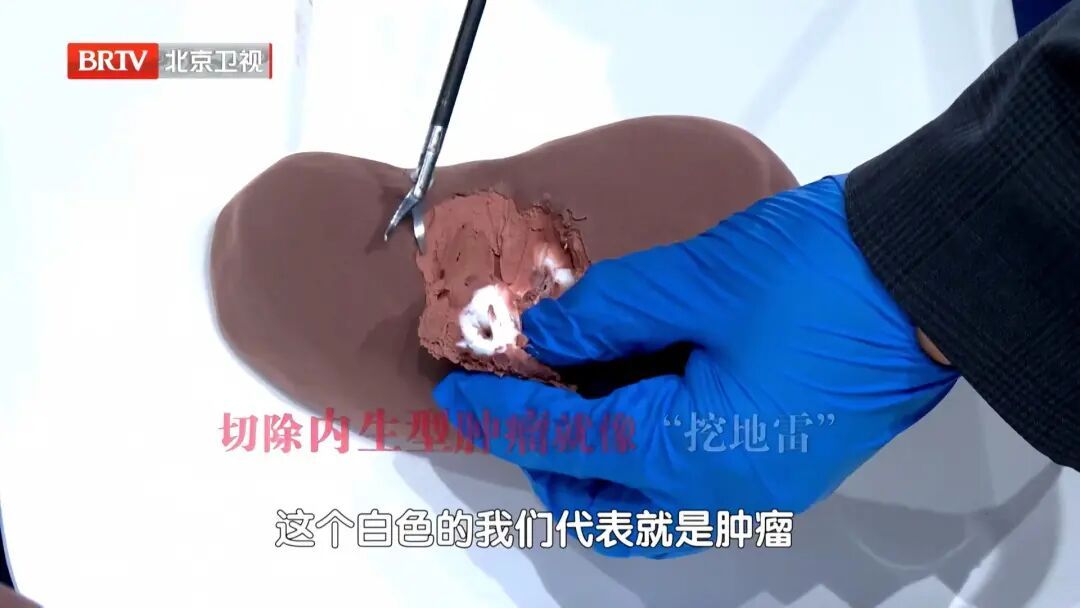 不痛不痒,一查竟是癌?血压有这个特点是信号,40岁以上尽快查 不痛不痒,一查竟是癌?血压有这个特点是信号,40岁以上尽快查
