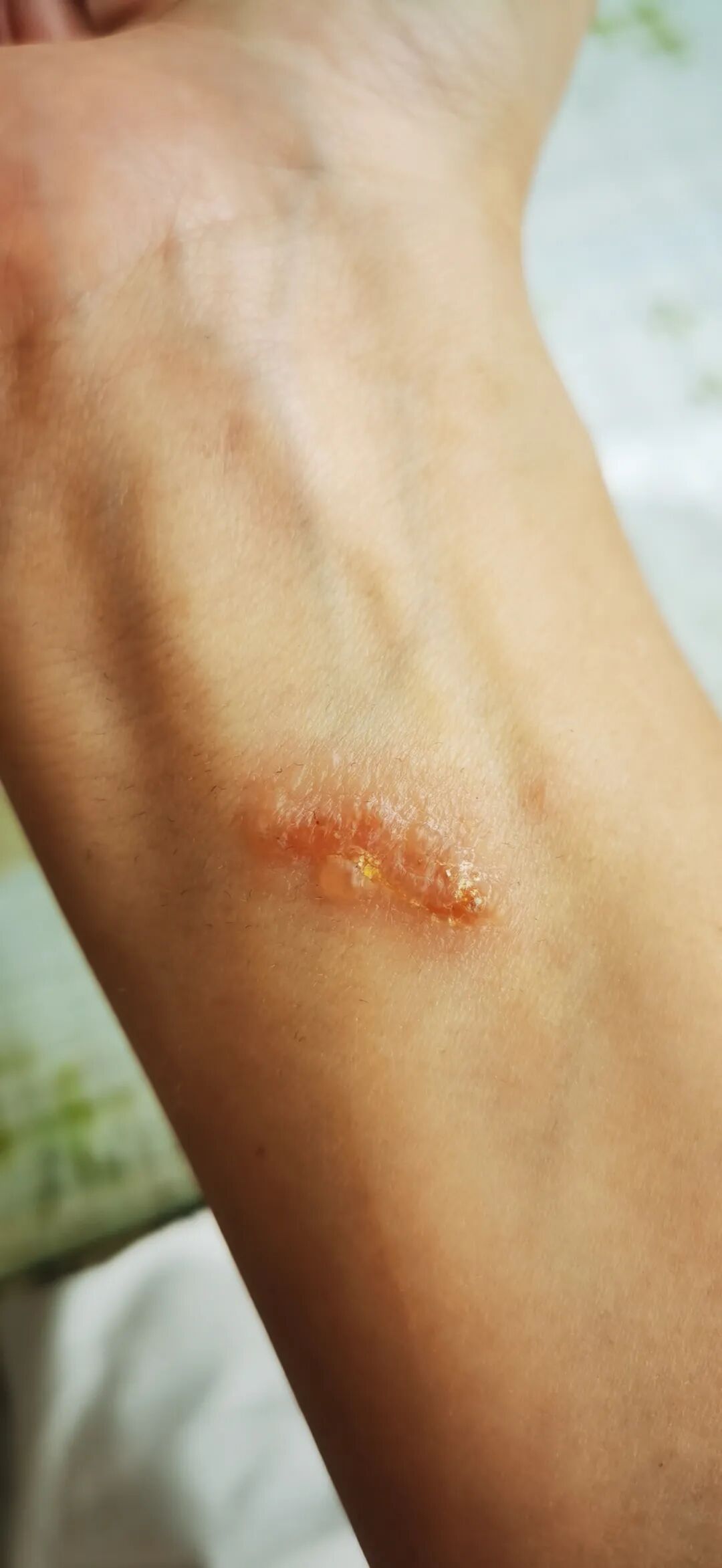 千万别碰！昆明已有人中招，专家提醒……