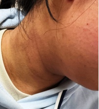 杭州一高中生天天喝奶茶,脖子越来越“脏”!医生:不是脏,是这里报警 杭州一高中生天天喝奶茶,脖子越来越“脏”!医生:不是脏,是这里报警