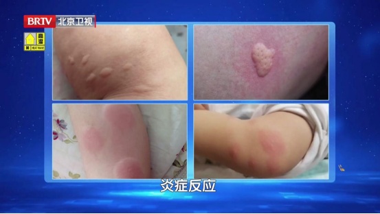 这种“蚊子包”千万别挠，可能引发感染化脓、甚至休克