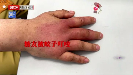这种“蚊子包”千万别挠，可能引发感染化脓、甚至休克