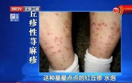 这种“蚊子包”千万别挠，可能引发感染化脓、甚至休克