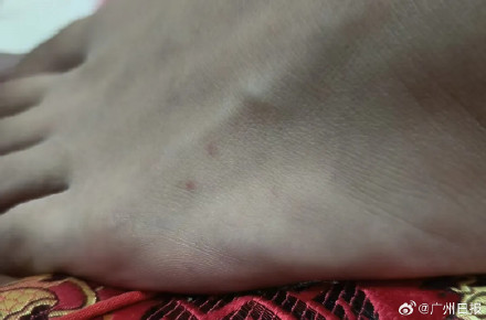 男子被毒蛇咬伤不痛不痒继续睡觉, 深夜一通电话救了他一命 男子被毒蛇咬伤不痛不痒继续睡觉, 深夜一通电话救了他一命