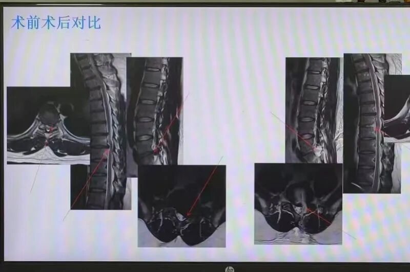 警惕 | 一觉醒来,男子双下肢瘫痪、大小便失禁!紧急提醒...... 警惕 | 一觉醒来,男子双下肢瘫痪、大小便失禁!紧急提醒......