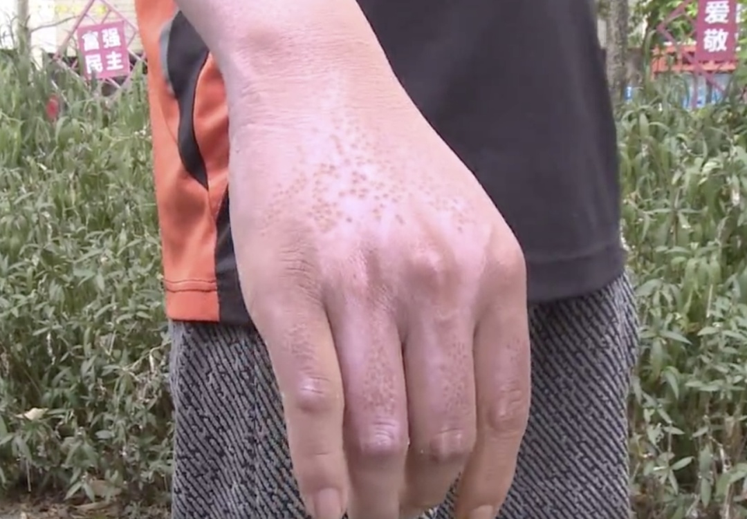 外卖骑手救火后遭遇复燃被烧伤,他说下次仍会选择挺身而出! 外卖骑手救火后遭遇复燃被烧伤,他说下次仍会选择挺身而出!