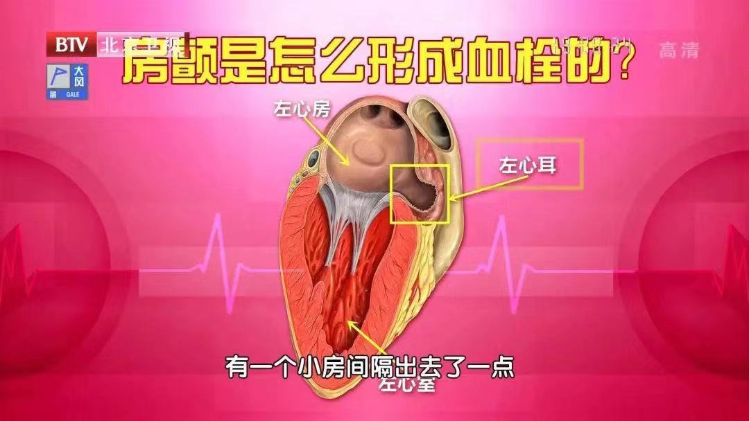 心脏“咯噔”一下，是猝死信号还是中风前兆？有人硬扛4年，体内悄悄长出血栓