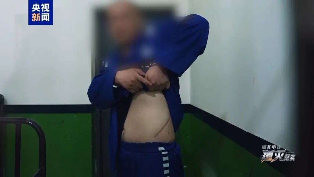 男子自述在缅北被割肾经历:只要能走,锯腿、锯手都愿意…… 男子自述在缅北被割肾经历:只要能走,锯腿、锯手都愿意……