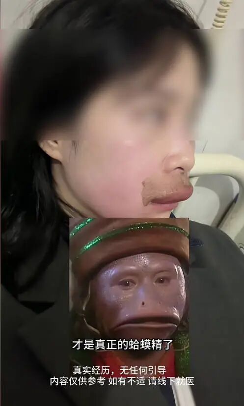 嘴唇肿胀自嘲“像蛤蟆精”，新娘婚礼前马蜂蜇伤后续来了！