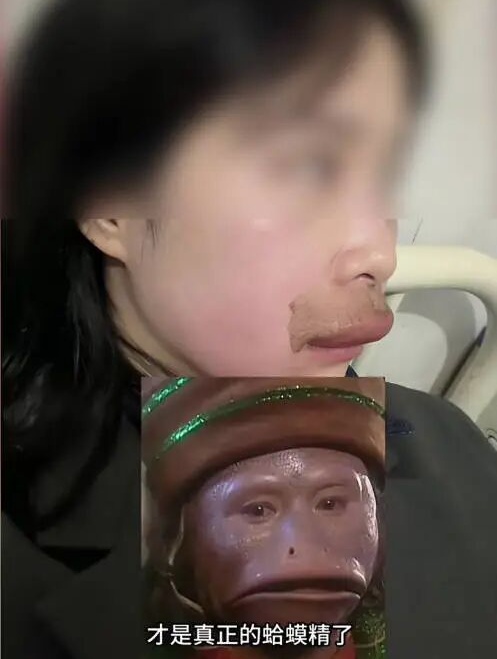 新娘婚礼前两天在家被马蜂蜇伤,嘴唇肿胀自嘲"像蛤蟆精";医生提醒→ 新娘婚礼前两天在家被马蜂蜇伤,嘴唇肿胀自嘲"像蛤蟆精";医生提醒→