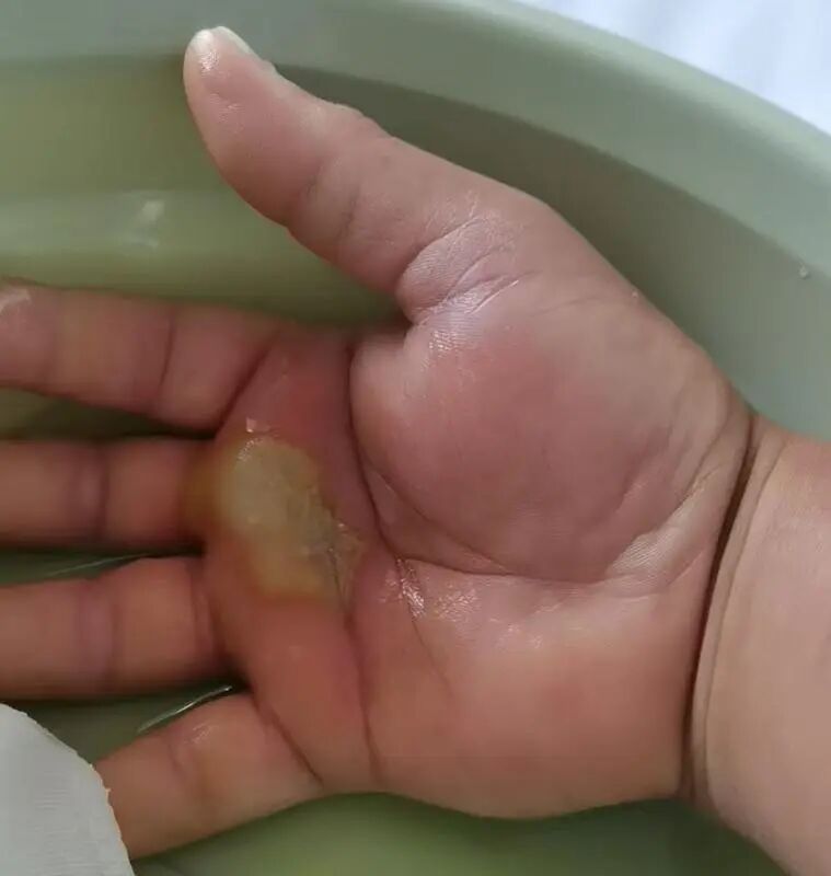 鱼刺扎一下，差点被“吃”掉？医生提醒：72小时不干预，病死率近100%