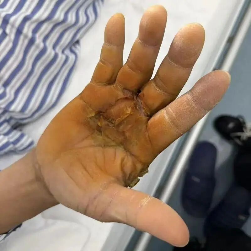 鱼刺扎一下，差点被“吃”掉？医生提醒：72小时不干预，病死率近100%
