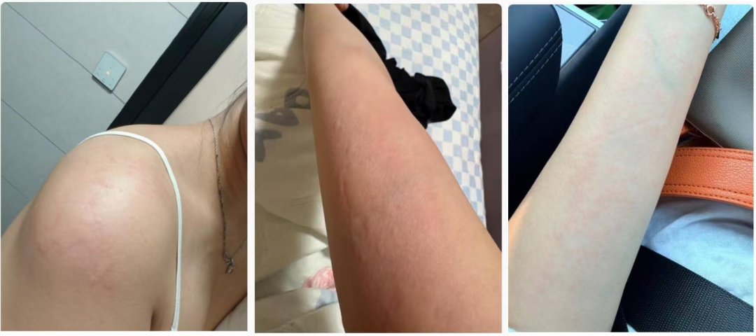 秋冬“风疙瘩”找上门!止痒第一步千万别做这件事! 秋冬“风疙瘩”找上门!止痒第一步千万别做这件事!