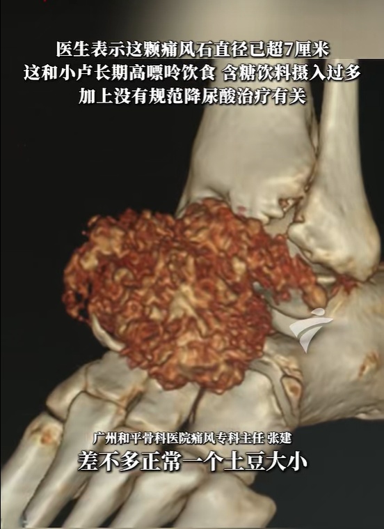 24岁男子脚上长出“土豆”,直径超过7厘米,走路都困难,医生紧急提醒 24岁男子脚上长出“土豆”,直径超过7厘米,走路都困难,医生紧急提醒