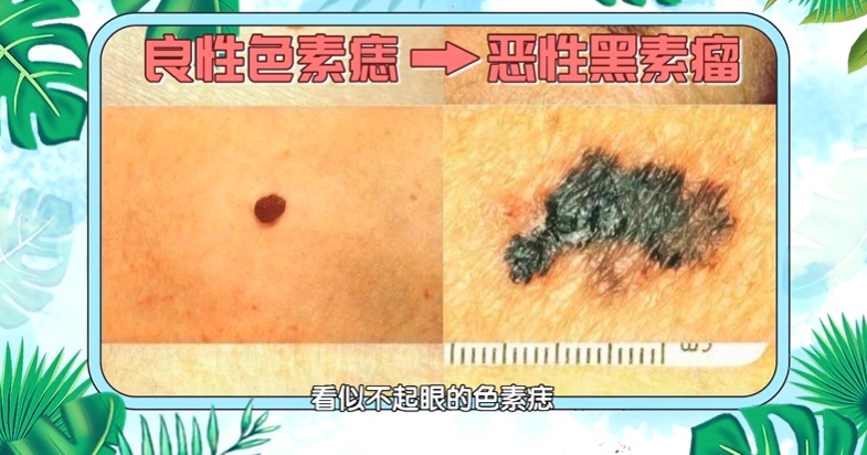 这个地方长痣，或比脚底更可能癌变！太多人从没留意过…