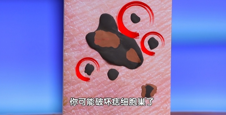 这个地方长痣，或比脚底更可能癌变！太多人从没留意过…