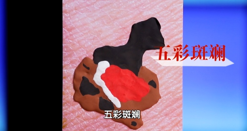 这个地方长痣，或比脚底更可能癌变！太多人从没留意过…