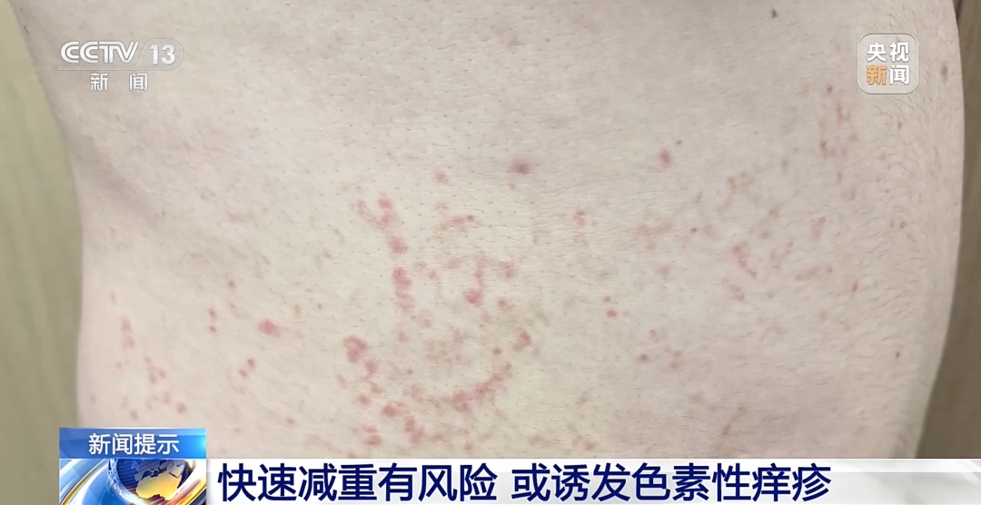 瘦了10公斤，红疹和脱发都来了……