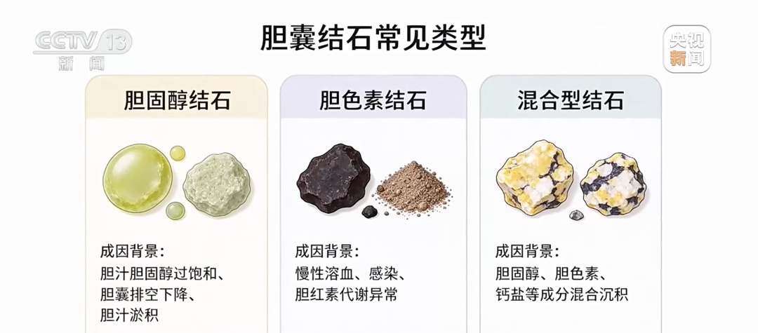 患者胆囊内取出270多枚结石!紧急提醒→ 患者胆囊内取出270多枚结石!紧急提醒→