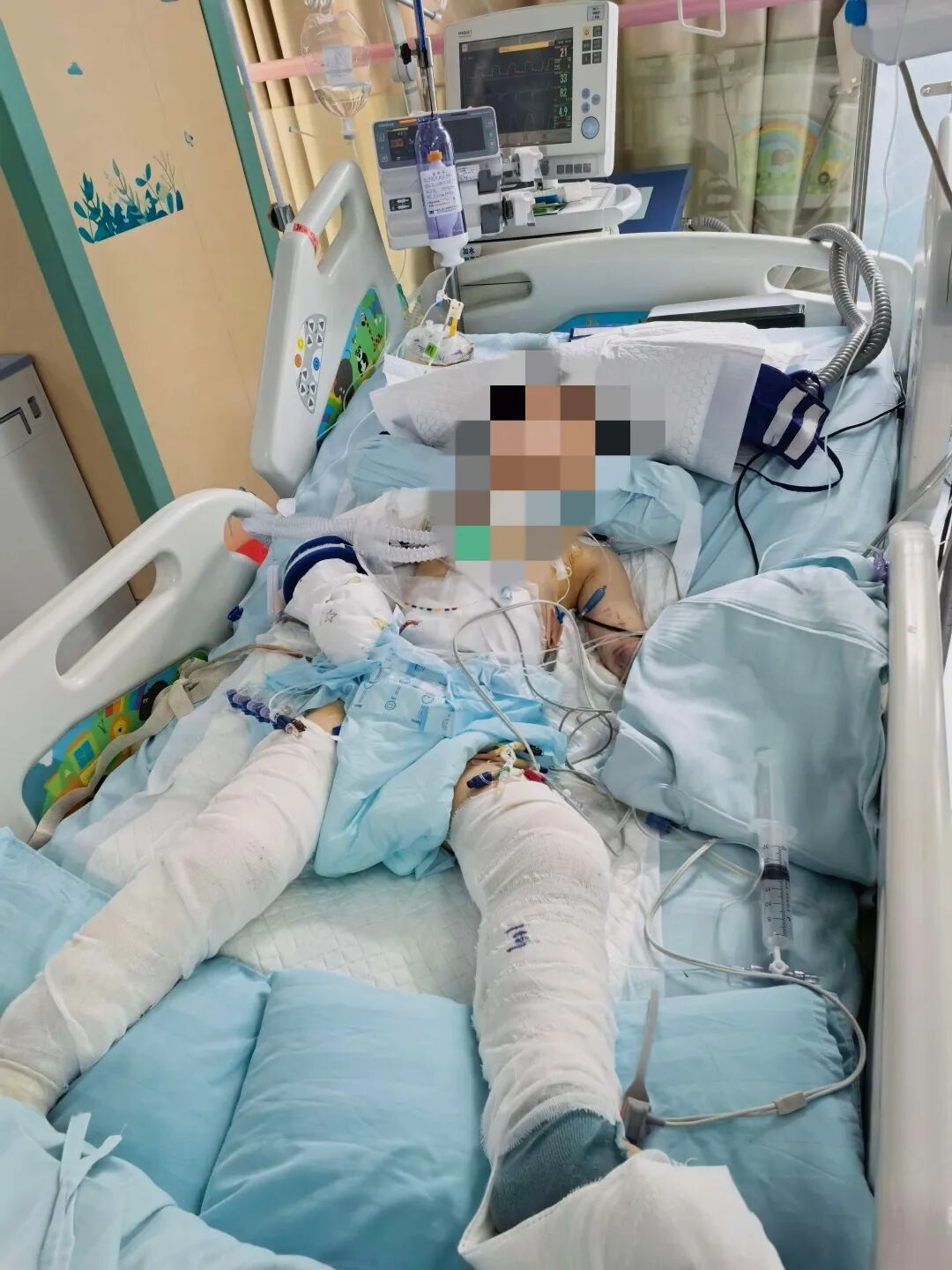 贵阳5岁男孩12楼坠落,奇迹生还!医生:他很坚强 贵阳5岁男孩12楼坠落,奇迹生还!医生:他很坚强