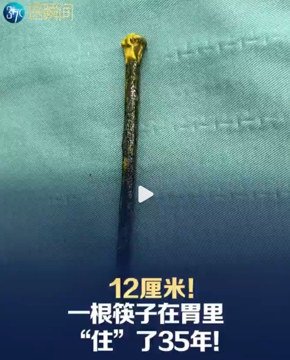 12厘米!一根筷子竟在男子胃里“住”了35年!医生手术取出,筷子已发黑腐蚀 12厘米!一根筷子竟在男子胃里“住”了35年!医生手术取出,筷子已发黑腐蚀