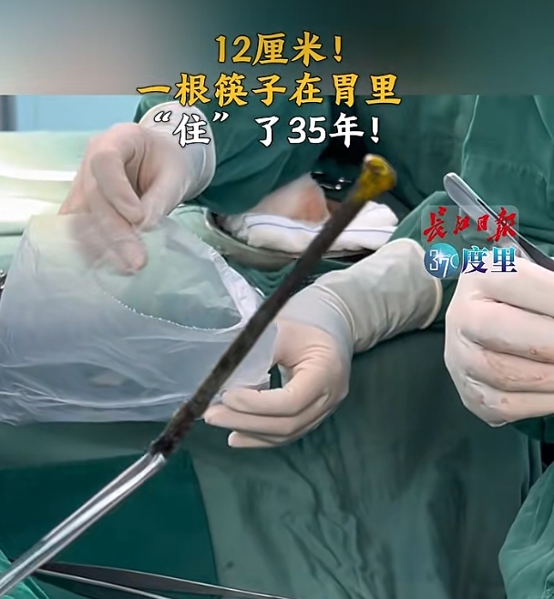 12厘米!一根筷子竟在男子胃里“住”了35年!医生手术取出,筷子已发黑腐蚀 12厘米!一根筷子竟在男子胃里“住”了35年!医生手术取出,筷子已发黑腐蚀
