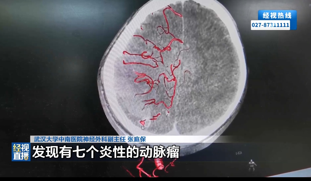 10岁男孩徒手拔烂牙,几个月后突发大量脑出血!医生提醒 10岁男孩徒手拔烂牙,几个月后突发大量脑出血!医生提醒