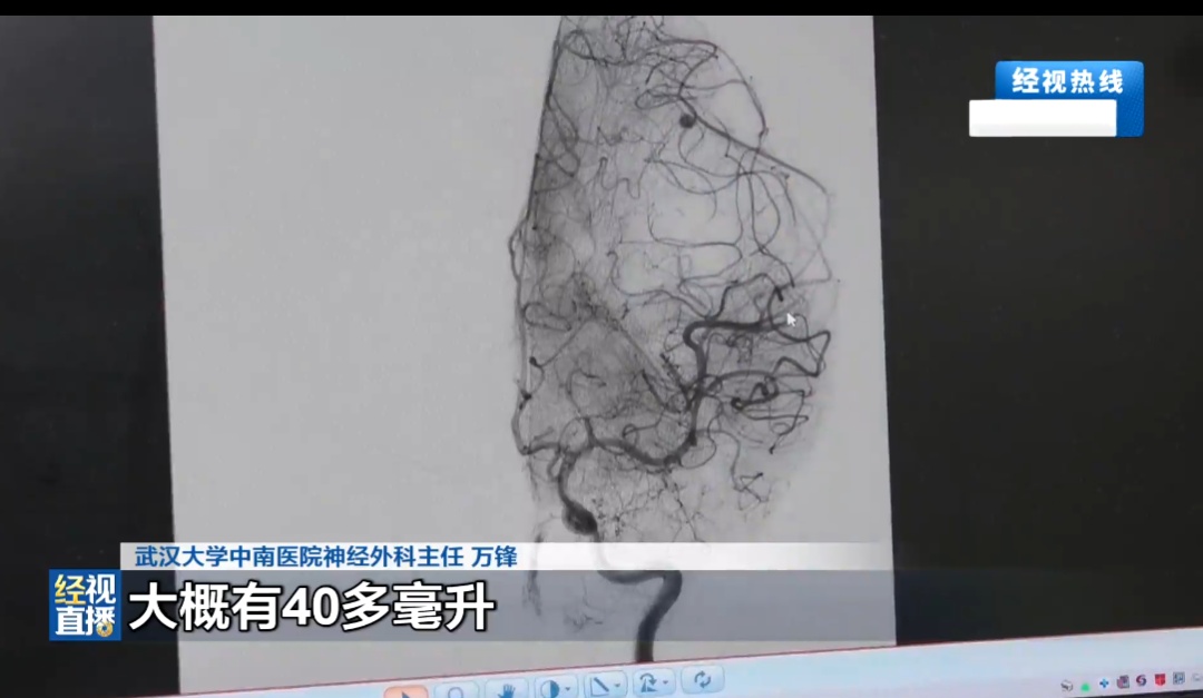 10岁男孩徒手拔烂牙，几个月后突发大量脑出血，一侧肢体偏瘫伴随失语！医生提醒