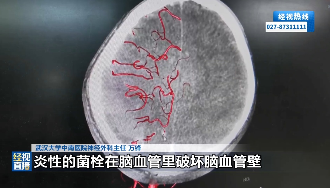 10岁男孩徒手拔烂牙，几个月后突发大量脑出血，一侧肢体偏瘫伴随失语！医生提醒