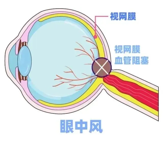 眼睛像被石子砸中一样,感觉有水在晃!警惕,这种病中青年患者越来越多… 眼睛像被石子砸中一样,感觉有水在晃!警惕,这种病中青年患者越来越多…
