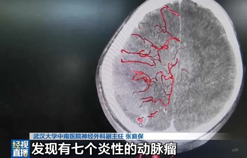 10岁男孩徒手拔烂牙,几个月后突发大量脑出血 10岁男孩徒手拔烂牙,几个月后突发大量脑出血